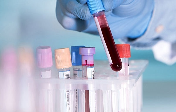 بیماری‌ ها چه اثراتی بر آزمایش خون دارند؟